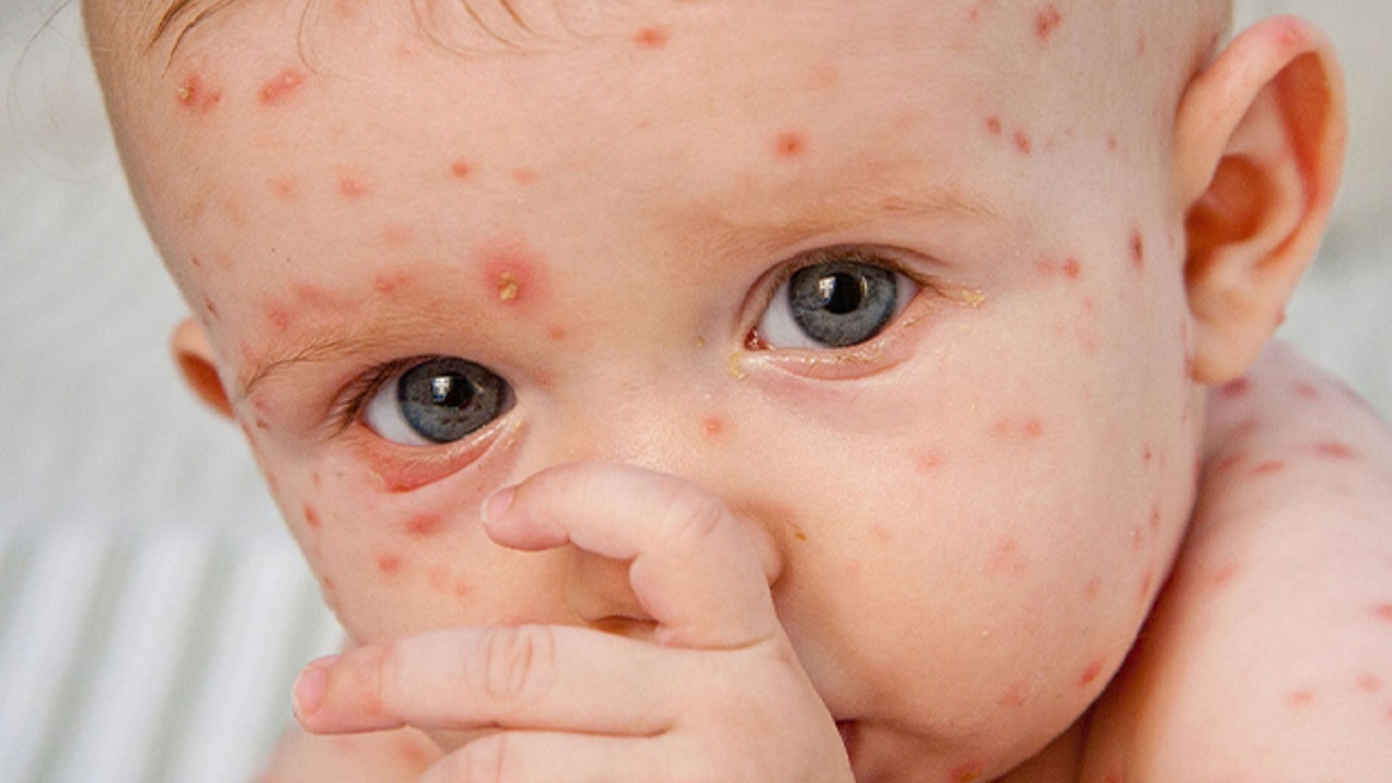 با دیدن کدام علائم به آبله مرغان باید شک کرد؟