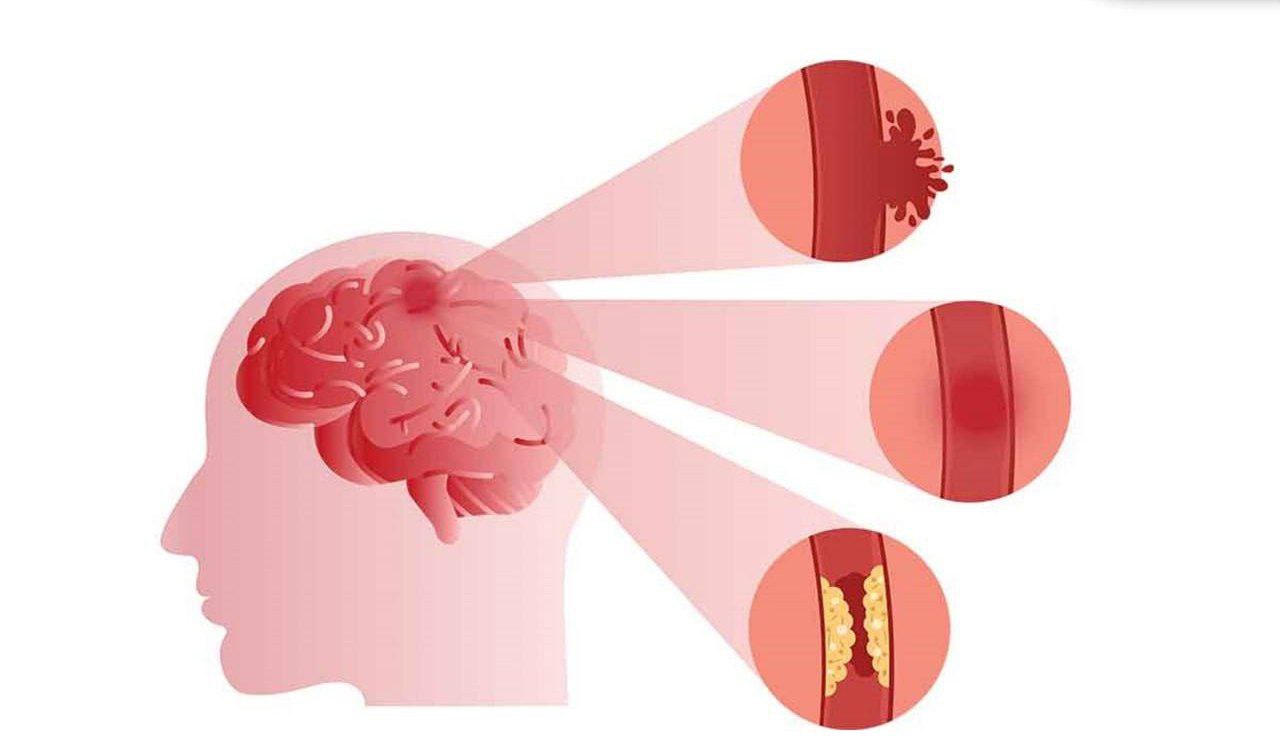 • اشتباهات بزرگی که باعث سکته مغزی میشود: