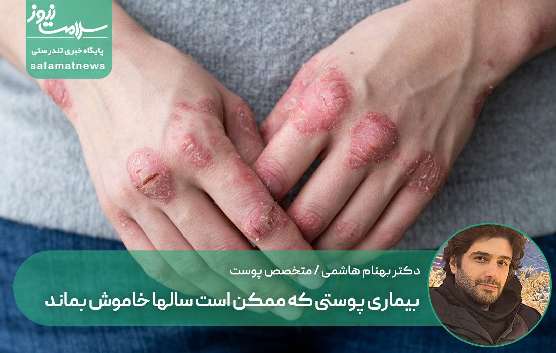 بیماری پوستی که ممکن است سالها خاموش بماند بیماری پوستی که ممکن است سالها خاموش بماند