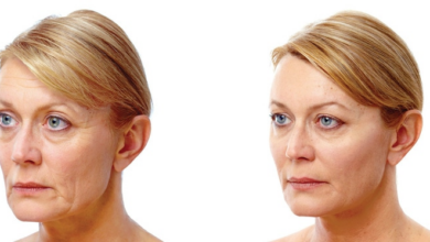 عکس تزریق ژل گونه قبل و بعد