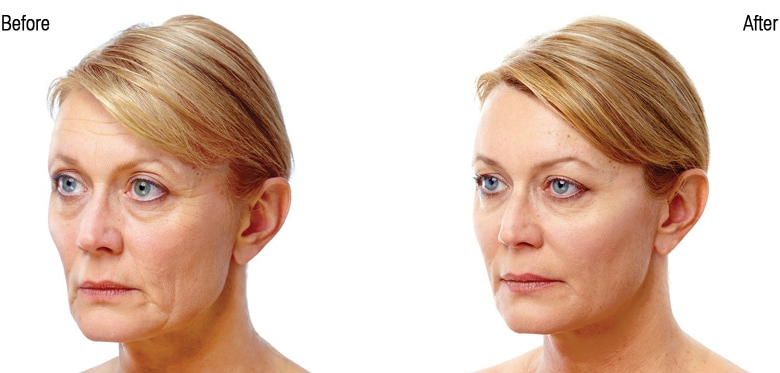 عکس تزریق ژل گونه قبل و بعد