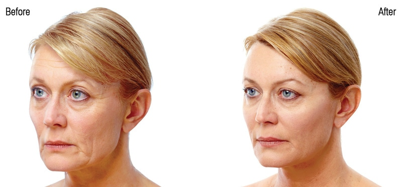 عکس تزریق ژل گونه قبل و بعد