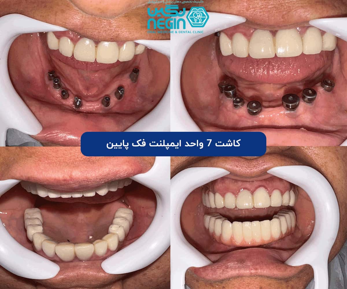 از کشیدن دندان تا لبخند جدید در یک جلسه: همه چیز درباره ایمپلنت فوری کاشت 7 واحد ایمپلنت فک پایین