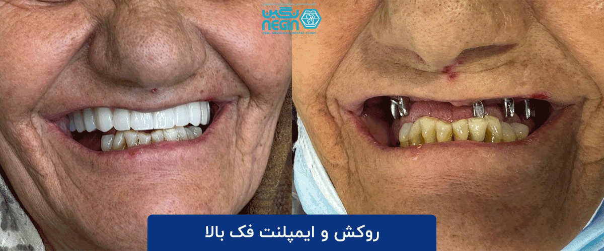 از کشیدن دندان تا لبخند جدید در یک جلسه: همه چیز درباره ایمپلنت فوری روکش و ایمپلنت فک بالا