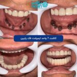 از کشیدن دندان تا لبخند جدید در یک جلسه: همه چیز درباره ایمپلنت فوری