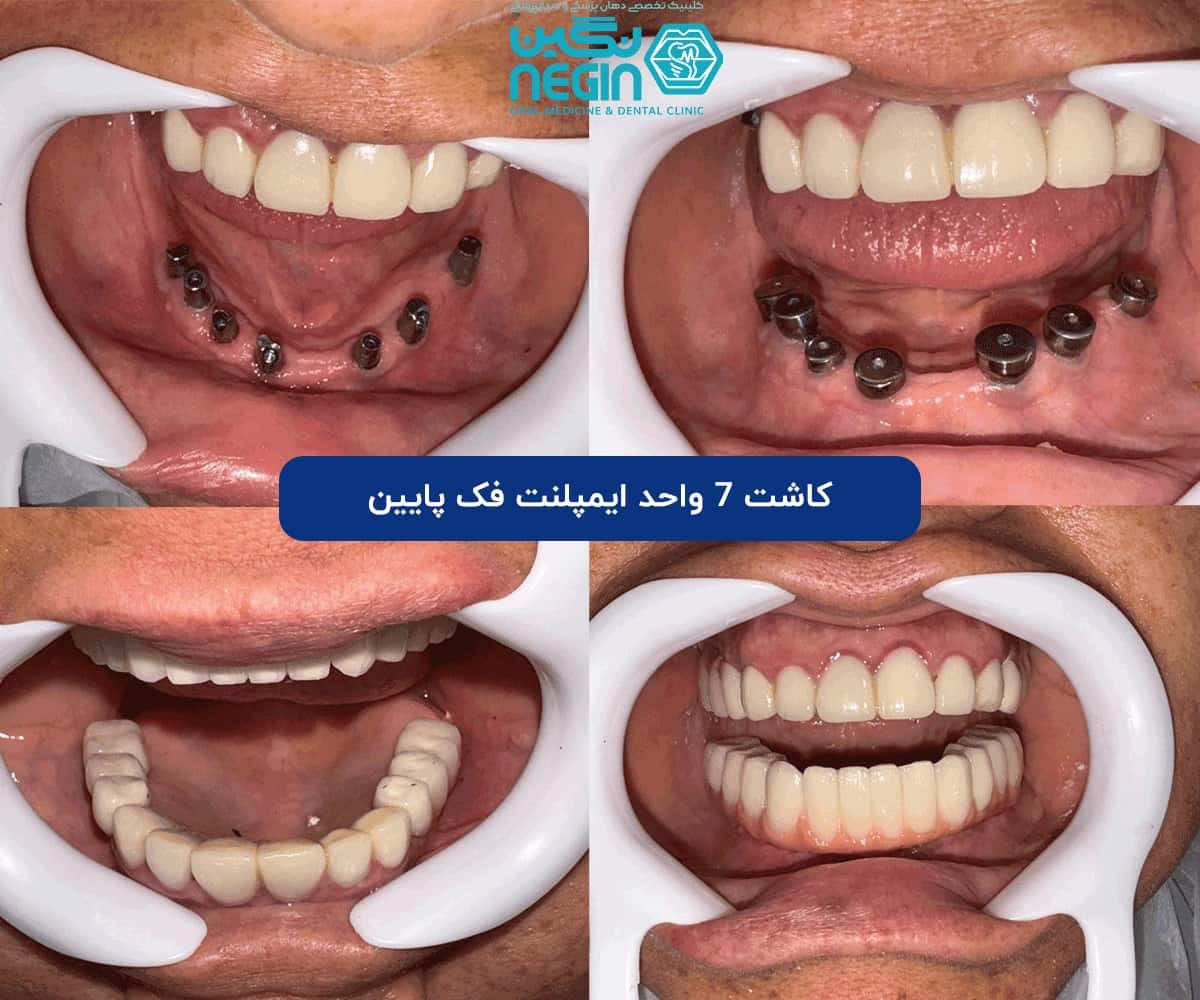 از کشیدن دندان تا لبخند جدید در یک جلسه: همه چیز درباره ایمپلنت فوری از کشیدن دندان تا لبخند جدید در یک جلسه: همه چیز درباره ایمپلنت فوری