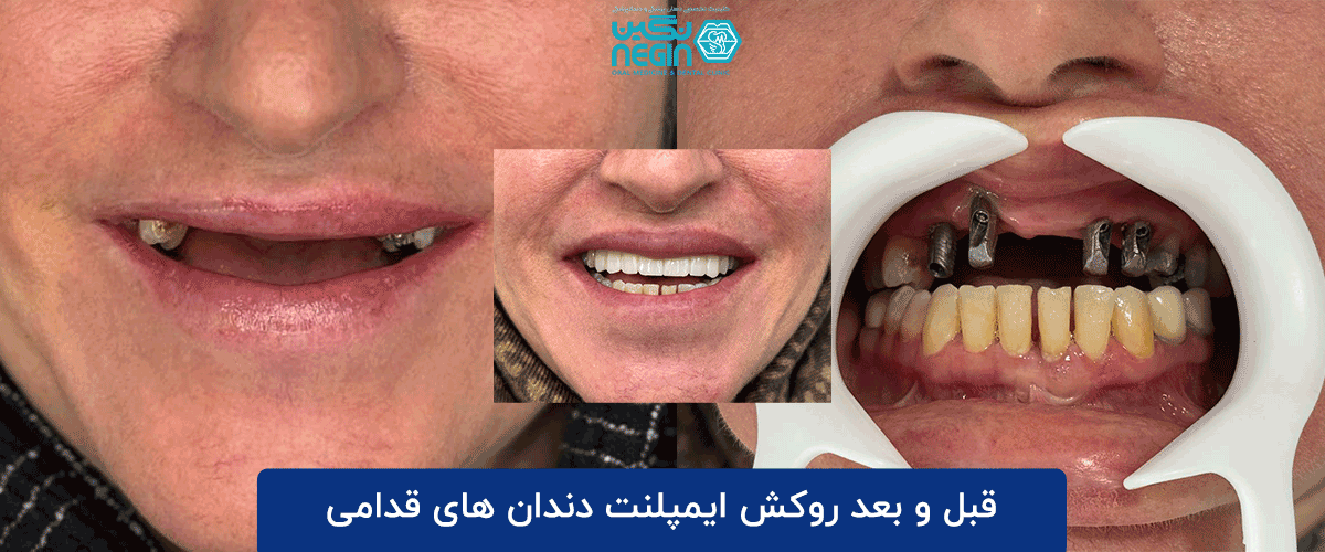 از کشیدن دندان تا لبخند جدید در یک جلسه: همه چیز درباره ایمپلنت فوری قبل و بعد روکش ایمپلنت دندان های قدامی