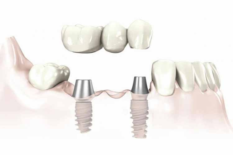 تکنولوژی ایمپلنت دندان