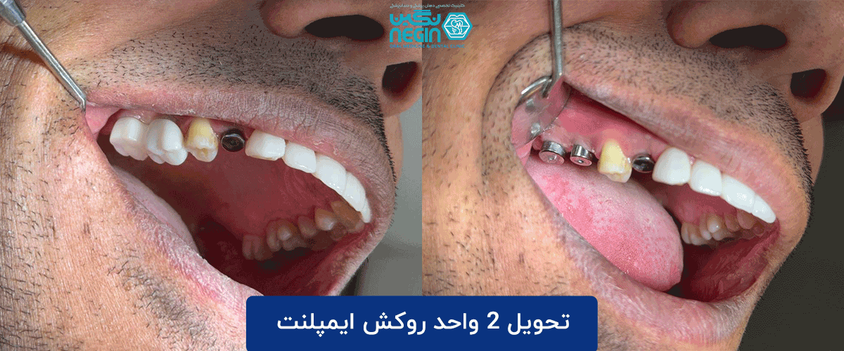 از کشیدن دندان تا لبخند جدید در یک جلسه: همه چیز درباره ایمپلنت فوری تحویل 2 واحد روکش ایمپلنت