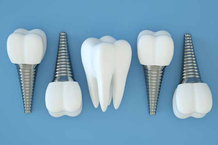 قیمت ایمپلنت تهران