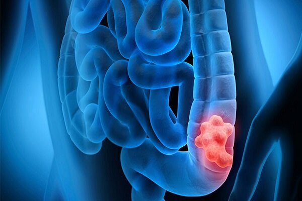 شناسایی علائم هشدار دهنده مولکولی اولیه بیماری التهابی روده شناسایی علائم هشدار دهنده مولکولی اولیه بیماری التهابی روده
